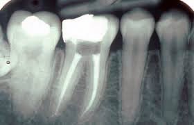 Àrea d'Odontologia i Cirurgia Oral i Maxil·lofacial - Endodòncia
